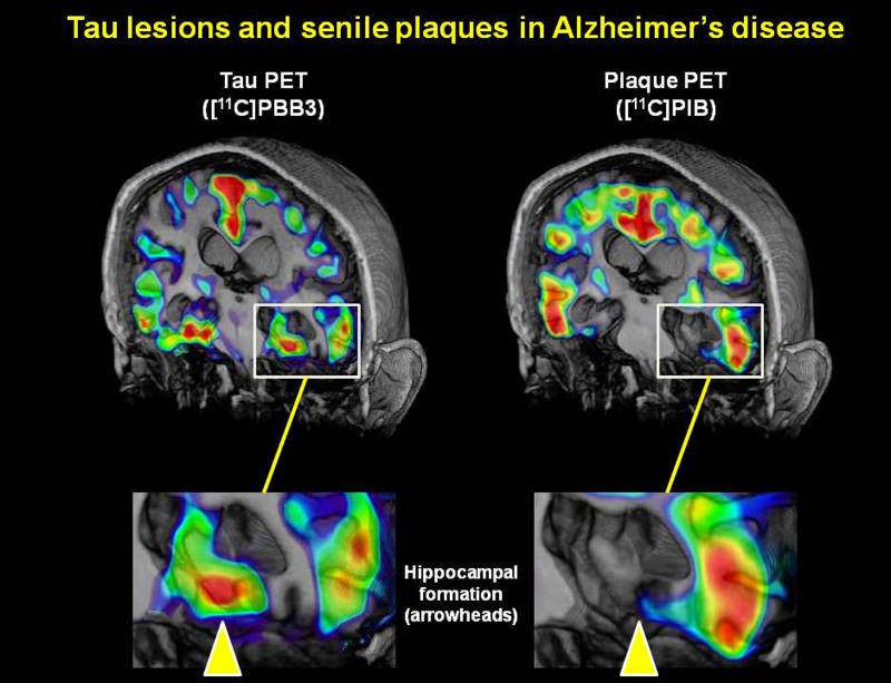 New imaging shows Alzheimer's unfolding in live brains New Scientist