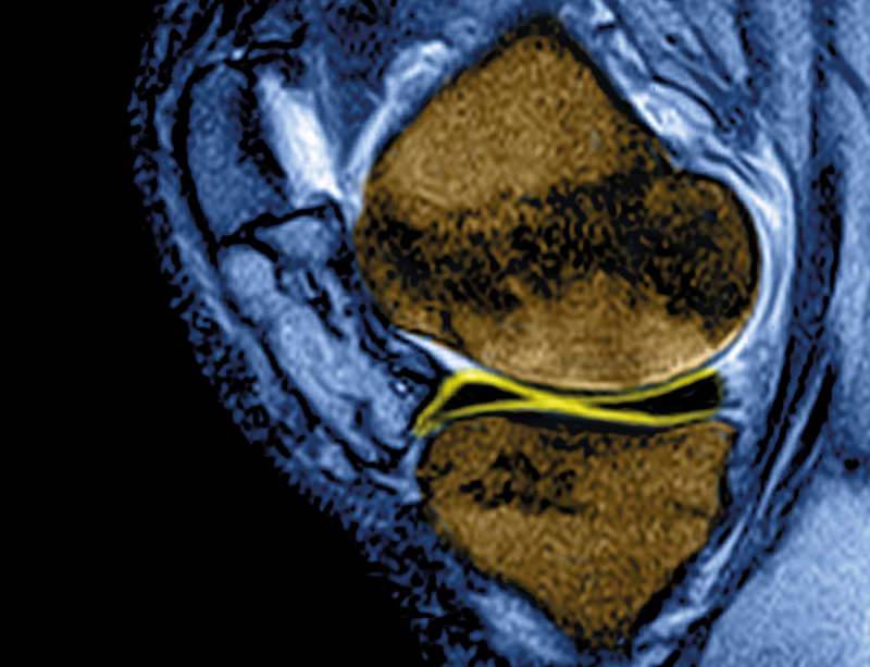 Wrecked knees? Nose cartilage can fix them New Scientist