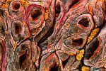 Microscope image of intestine tissue from someone with coeliac disease