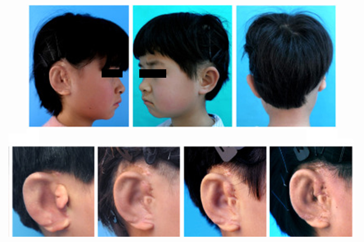 Children get new ears grown from their own cells in world first New
