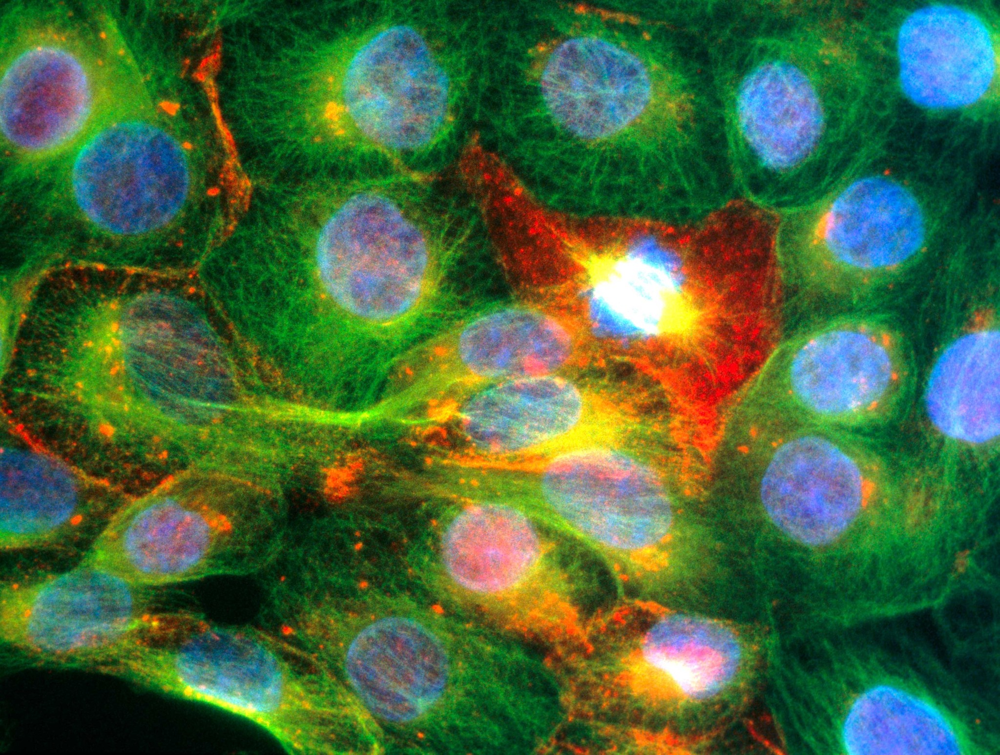 Prostate cancer cells